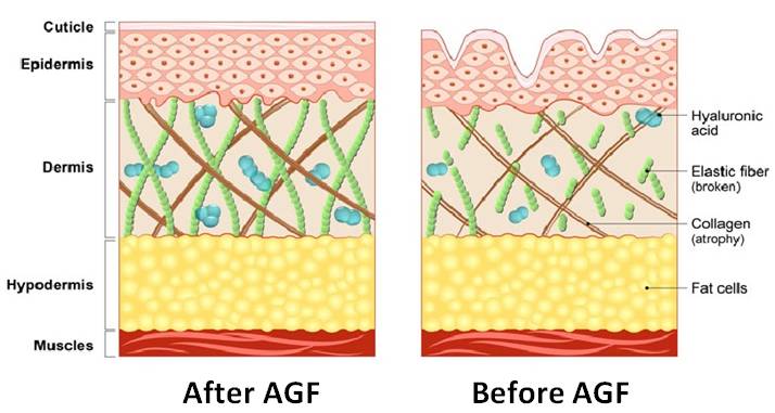 AGF for Skin rejuvenation Treatment in Bangalore