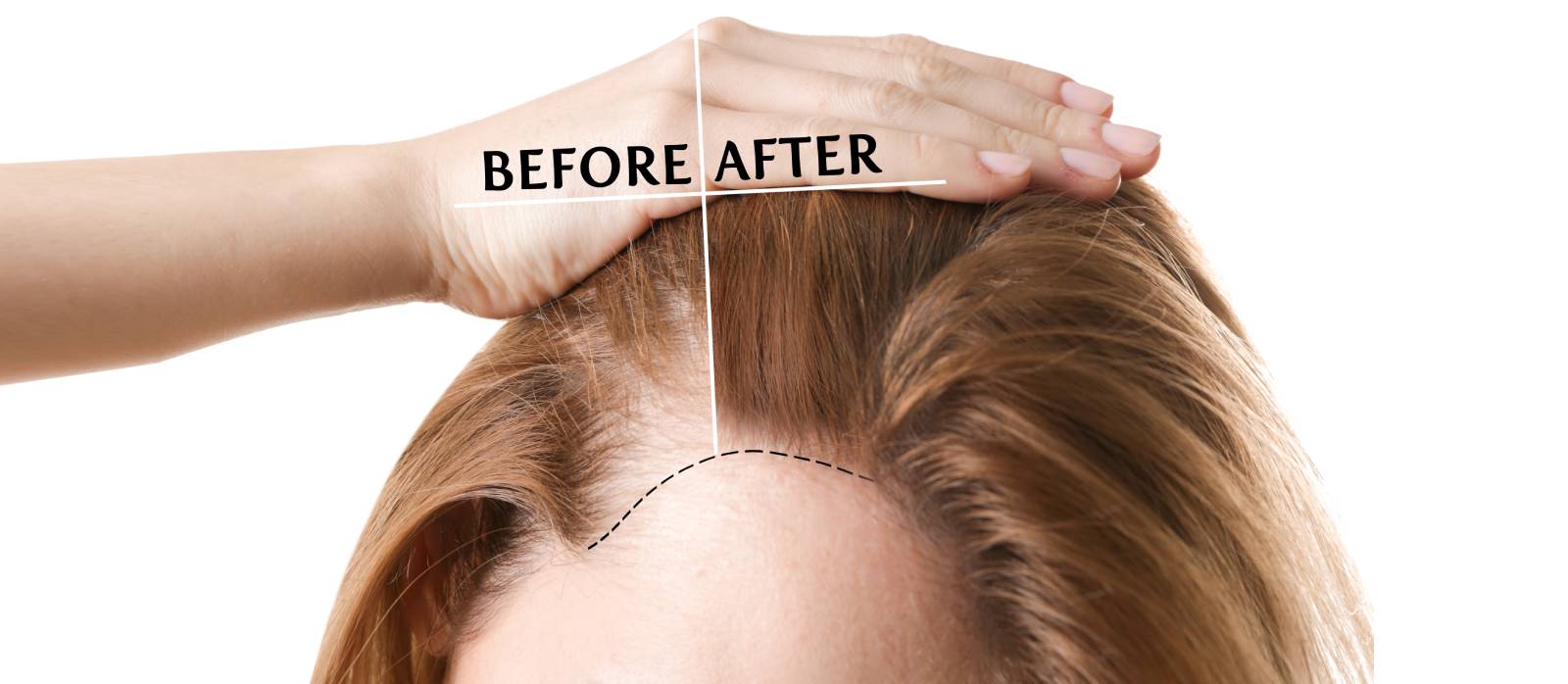 Growth Factor Concentrate Therapy for Hair Loss Treatment in Bangalore |  The Body Perfect Cosmetic Clinic
