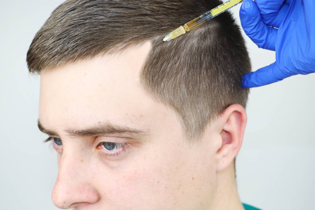 PRP Hair Regrowth Treatment in Bangalore